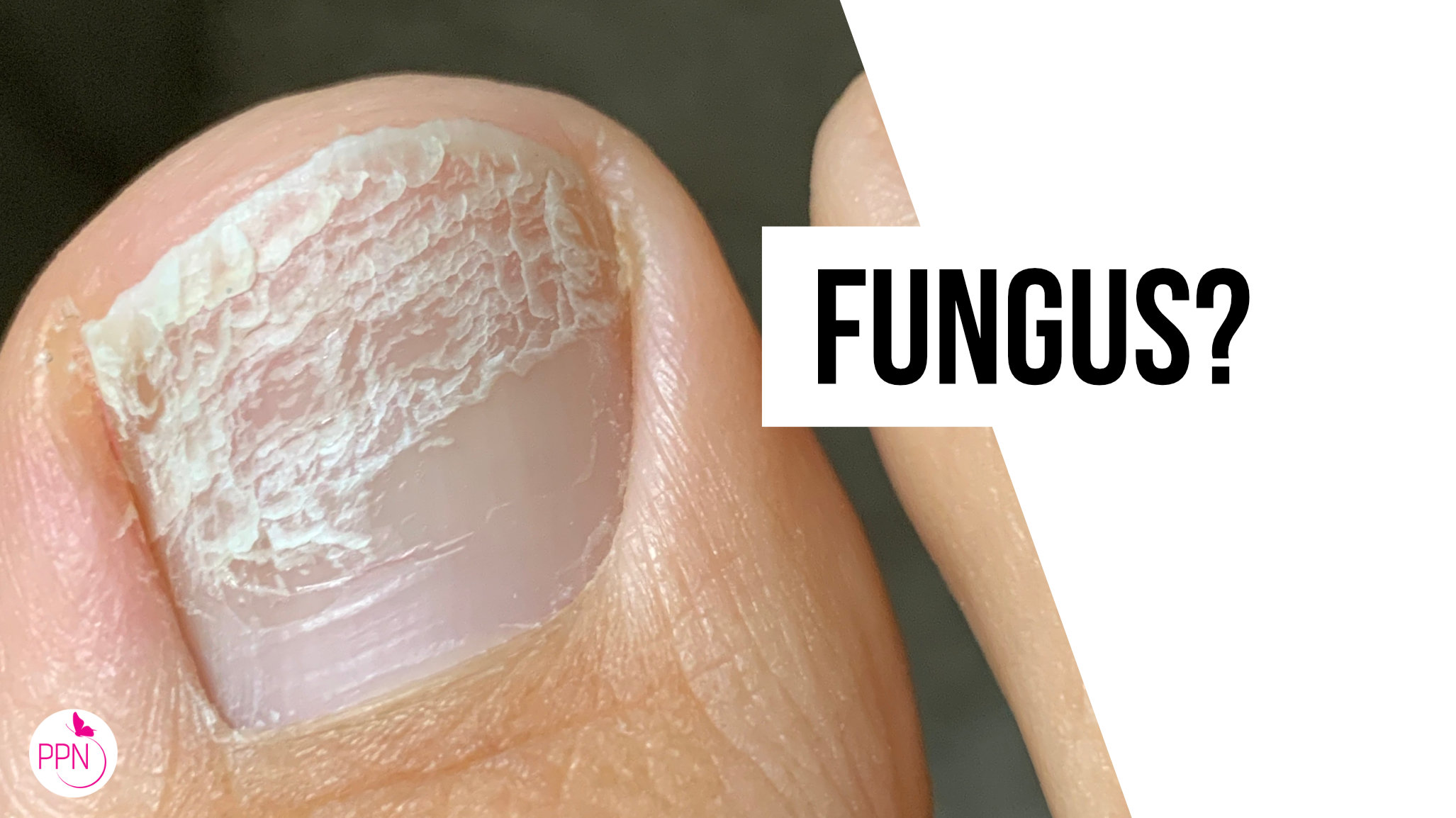 Nail Fungus Removal Treatment Cardiff by Beauty Advance Laser Clinic